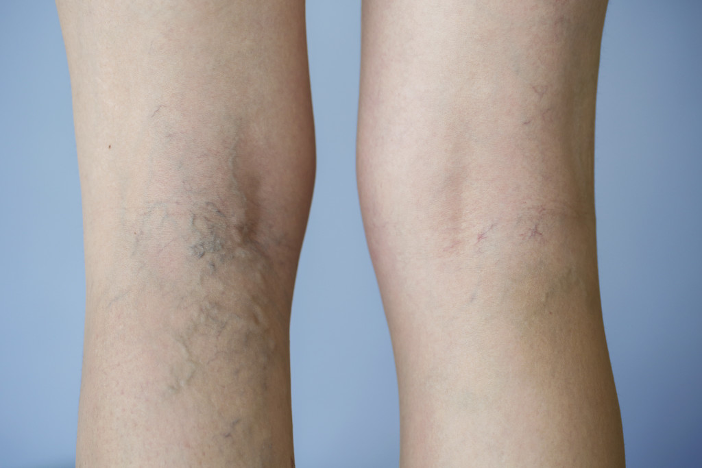 Varicose veins on a leg